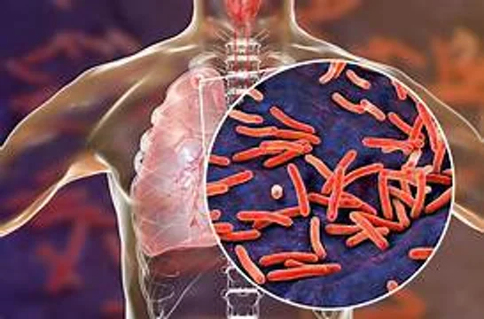 TUBERCULOSIS