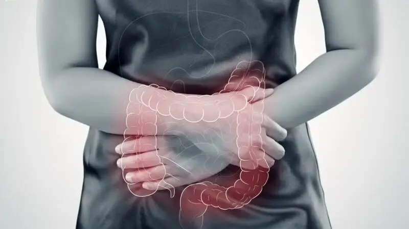 Enfermedad inflamatoria intestinal