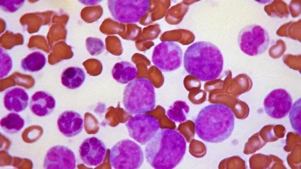 leucemia mieloide