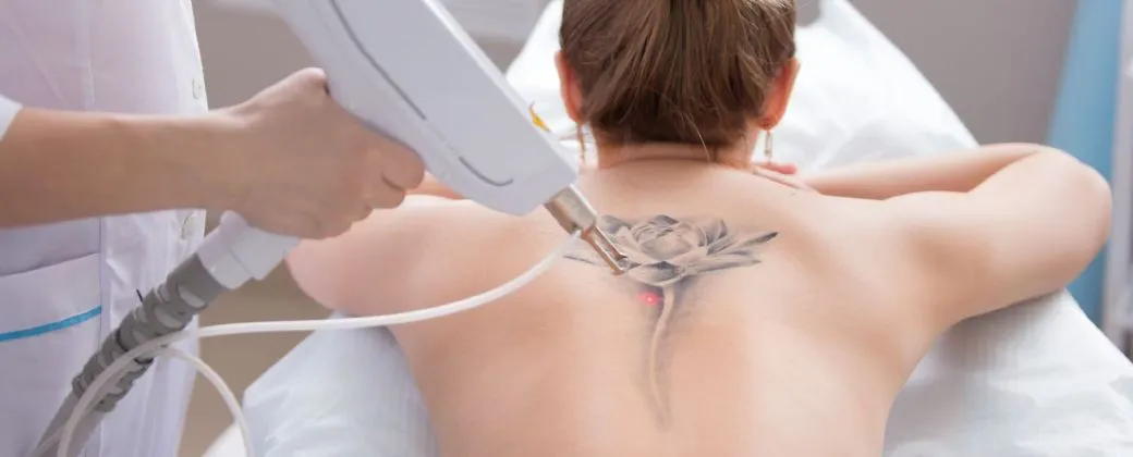 eliminacion tatuajes